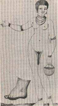 Deformación étnica. Exagerado desarrollo de las ninfas en una mujer hotentota. Jacques L. Moreau de la Sarthe, Histoire Naturelle de la Femme, París, 1803.